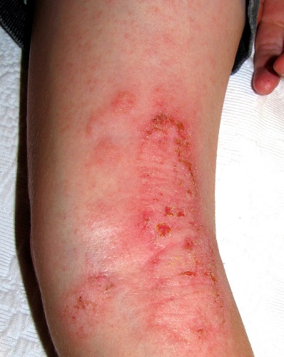 Eczema dermatose
